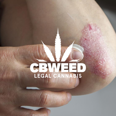 psoriasis